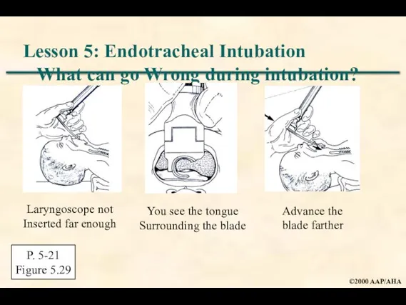 Lesson 5: Endotracheal Intubation What can go Wrong during intubation? Laryngoscope not