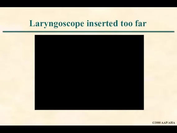 Laryngoscope inserted too far