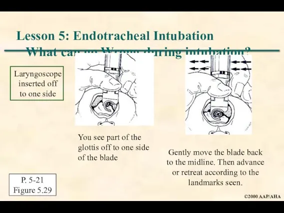 Lesson 5: Endotracheal Intubation What can go Wrong during intubation? P. 5-21