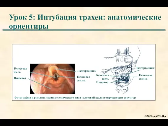 Урок 5: Интубация трахеи: анатомические ориентиры Фотография и рисунок ларингоскопического вида голосовой