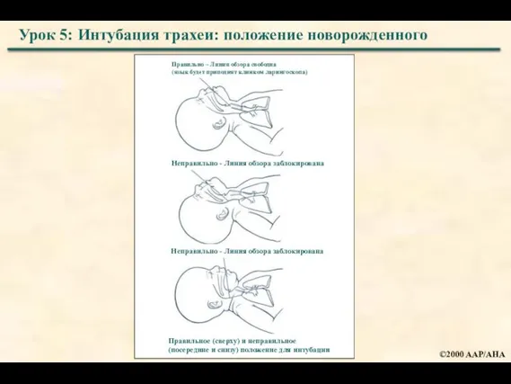 Урок 5: Интубация трахеи: положение новорожденного Правильно – Линия обзора свободна (язык