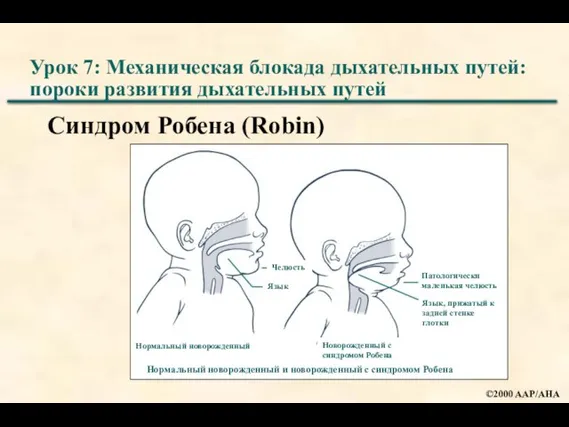 Урок 7: Механическая блокада дыхательных путей: пороки развития дыхательных путей Синдром Робена