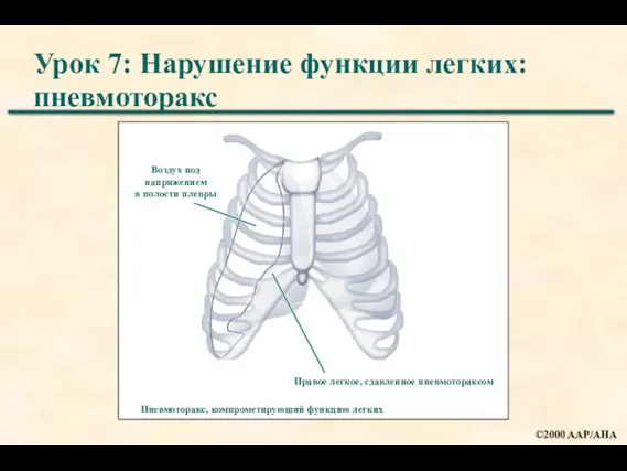 Урок 7: Нарушение функции легких: пневмоторакс Пневмоторакс, компрометирующий функцию легких Правое легкое,