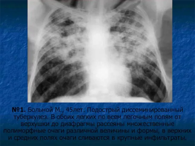 №1. Больной М., 45лет. Подострый диссеминированный туберкулез. В обоих легких по всем