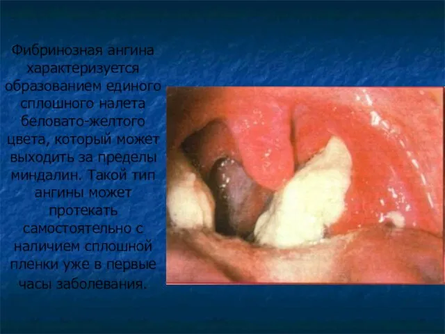 Фибринозная ангина характеризуется образованием единого сплошного налета беловато-желтого цвета, который может выходить