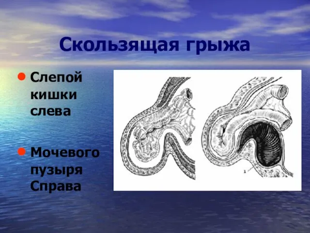 Скользящая грыжа Слепой кишки слева Мочевого пузыря Справа