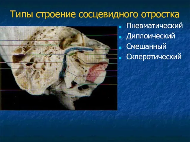 Типы строение сосцевидного отростка Пневматический Диплоический Смешанный Склеротический