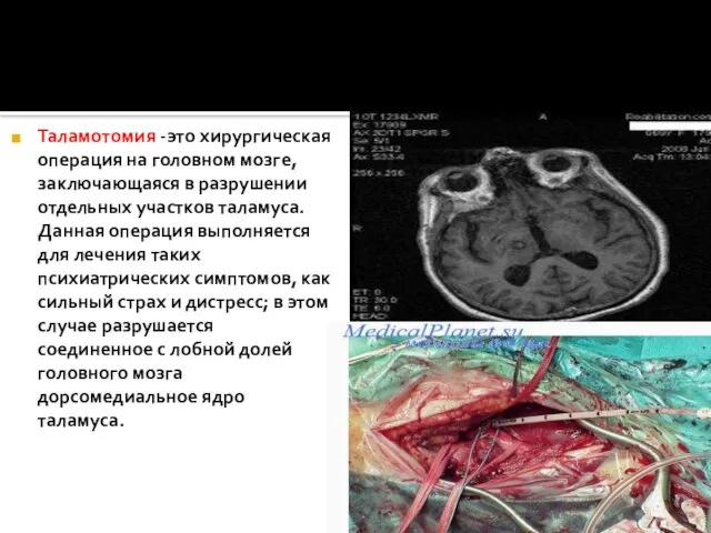 Таламотомия -это хирургическая операция на головном мозге, заключающаяся в разрушении отдельных участков