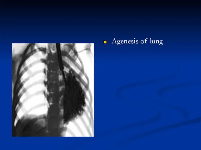 Agenesis of lung