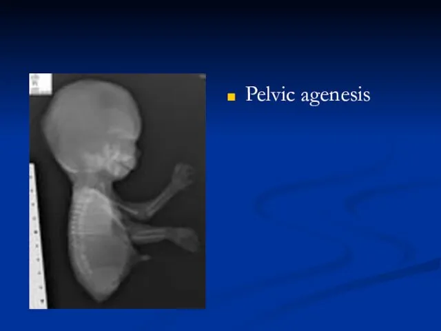 Pelvic agenesis