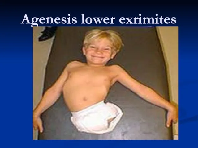 Agenesis lower exrimites