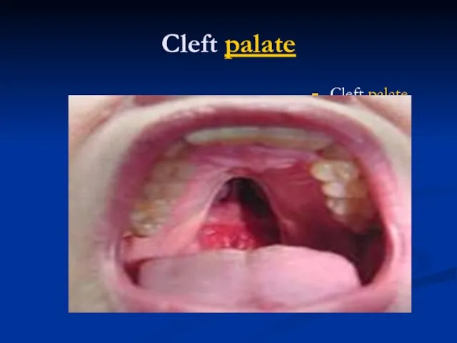 Cleft palate Cleft palate