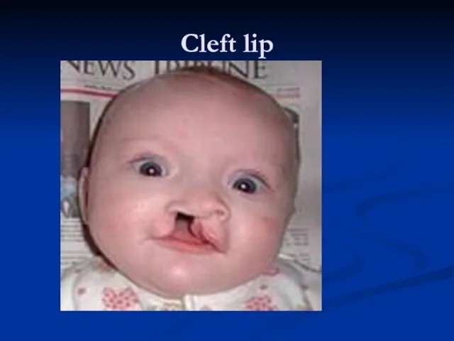 Cleft lip