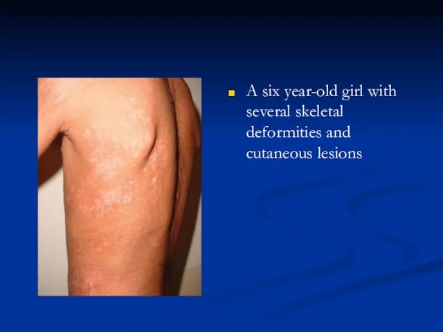 A six year-old girl with several skeletal deformities and cutaneous lesions
