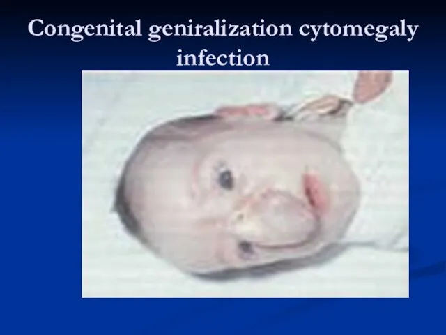 Congenital geniralization cytomegaly infection