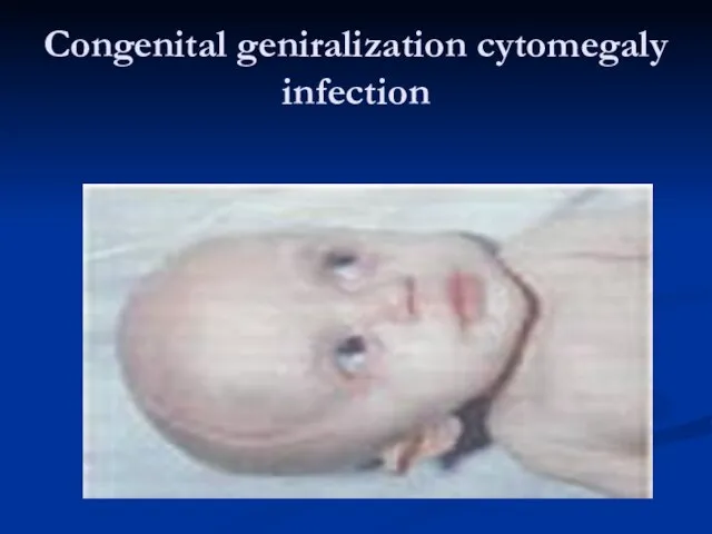 Congenital geniralization cytomegaly infection