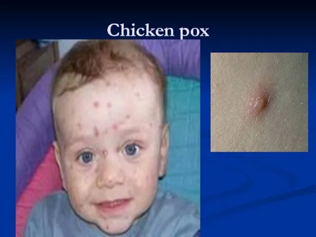 Chicken pox