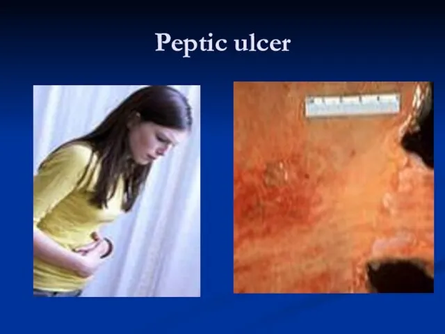 Peptic ulcer