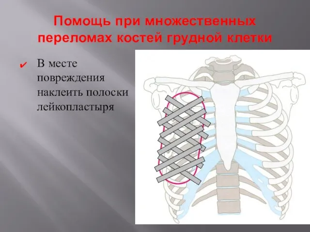 Помощь при множественных переломах костей грудной клетки В месте повреждения наклеить полоски лейкопластыря