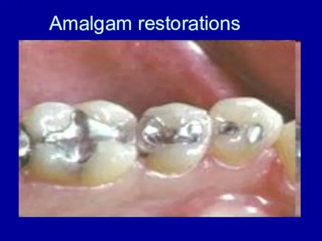 Amalgam restorations