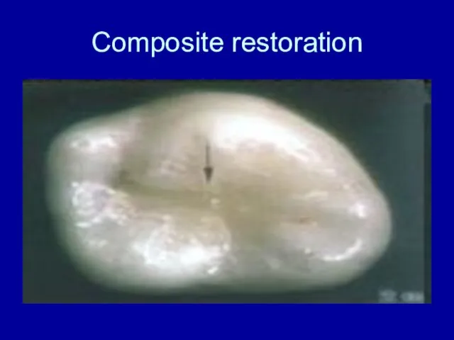 Composite restoration