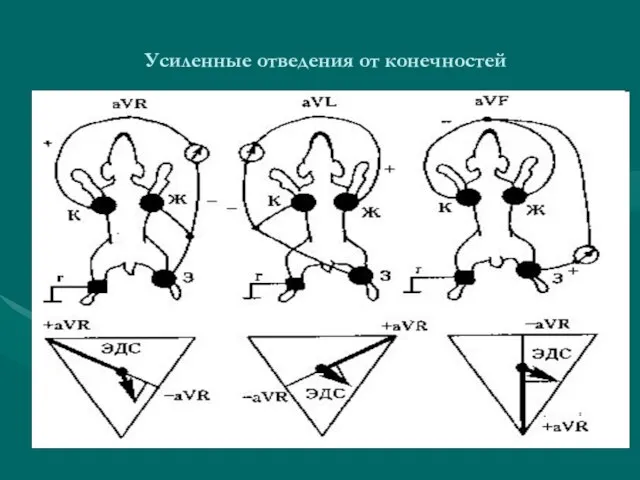 Усиленные отведения от конечностей