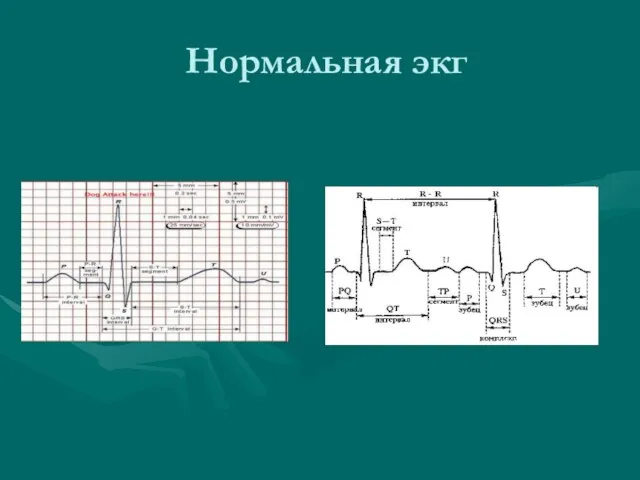 Нормальная экг