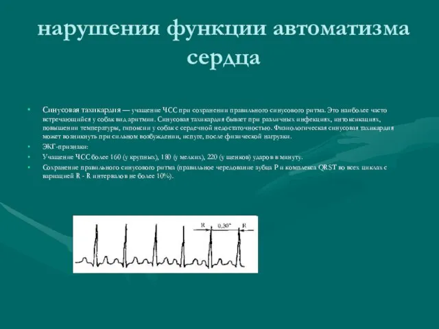 нарушения функции автоматизма сердца Синусовая тахикардия — учащение ЧСС при сохранении правильного