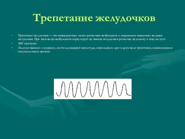 Трепетание желудочков Трепетание желудочков — это поверхностное частое ритмичное возбуждение и сокращение