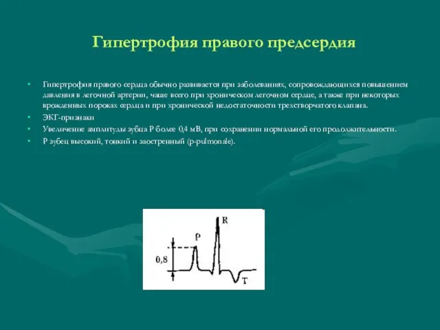 Гипертрофия правого предсердия Гипертрофия правого сердца обычно развивается при заболеваниях, сопровождающихся повышением