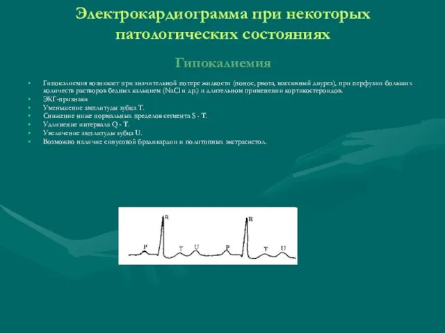 Электрокардиограмма при некоторых патологических состояниях Гипокалиемия Гипокалиемия возникает при значительной потере жидкости