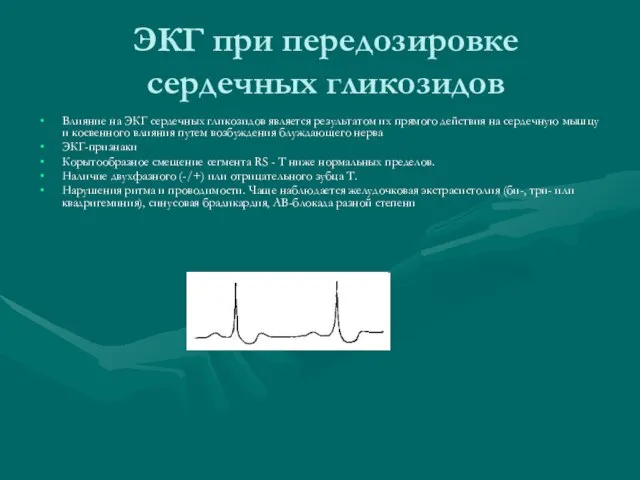 ЭКГ при передозировке сердечных гликозидов Влияние на ЭКГ сердечных гликозидов является результатом