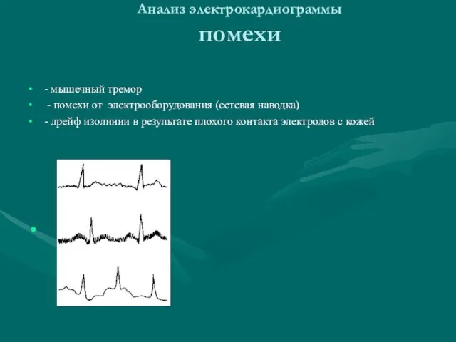 Анализ электрокардиограммы помехи - мышечный тремор - помехи от электрооборудования (сетевая наводка)