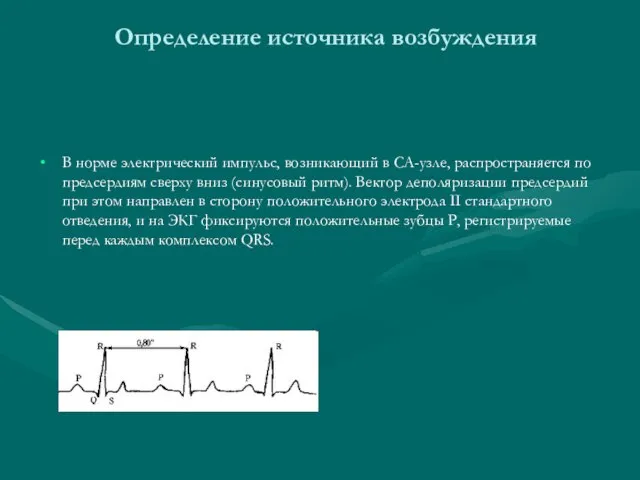 Определение источника возбуждения В норме электрический импульс, возникающий в СА-узле, распространяется по