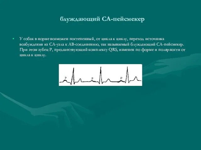 блуждающий СА-пейсмекер У собак в норме возможен постепенный, от цикла к циклу,