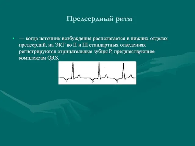 Предсердный ритм — когда источник возбуждения располагается в нижних отделах предсердий, на