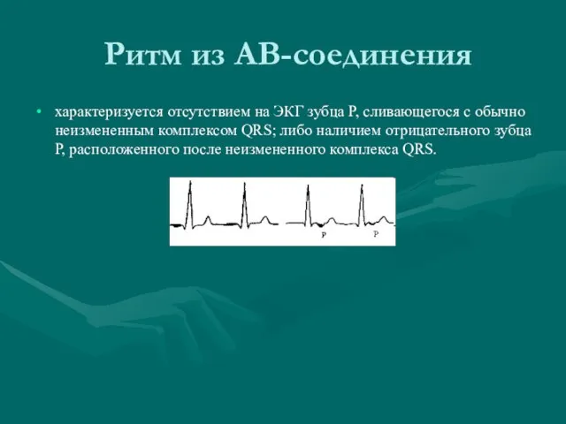 Ритм из АВ-соединения характеризуется отсутствием на ЭКГ зубца Р, сливающегося с обычно