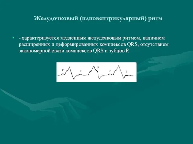 Желудочковый (идиовентрикулярный) ритм - характеризуется медленным желудочковым ритмом, наличием расширенных и деформированных