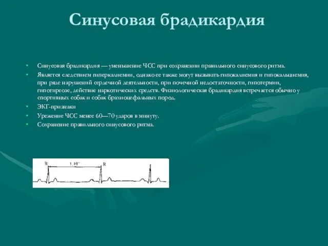 Синусовая брадикардия Синусовая брадикардия — уменьшение ЧСС при сохранении правильного синусового ритма.