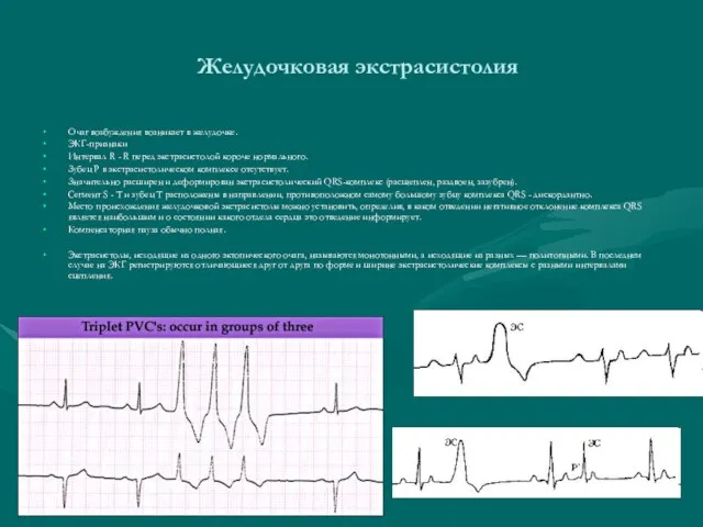 Желудочковая экстрасистолия Очаг возбуждения возникает в желудочке. ЭКГ-признаки Интервал R - R