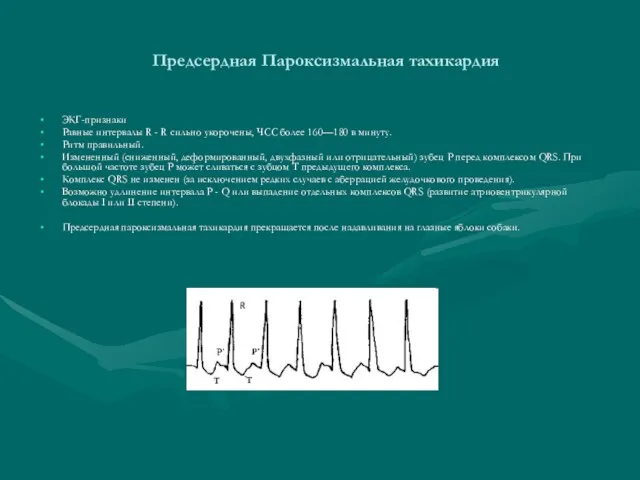 Предсердная Пароксизмальная тахикардия ЭКГ-признаки Равные интервалы R - R сильно укорочены, ЧСС