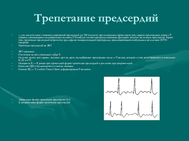 Трепетание предсердий — это значительное учащение сокращений предсердий (до 350 в минуту)