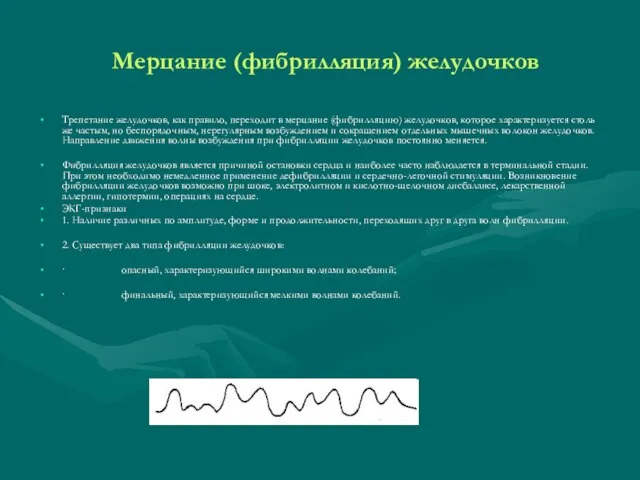 Мерцание (фибрилляция) желудочков Трепетание желудочков, как правило, переходит в мерцание (фибрилляцию) желудочков,