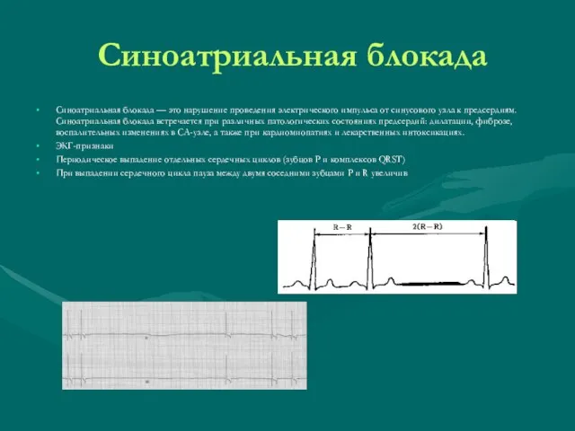 Синоатриальная блокада Синоатриальная блокада — это нарушение проведения электрического импульса от синусового