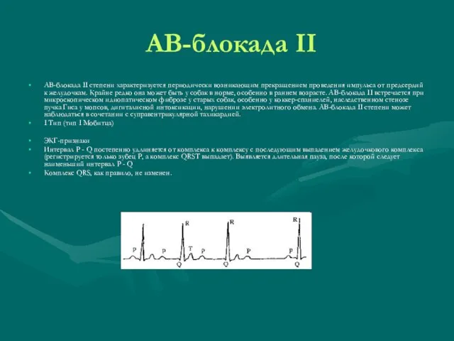 АВ-блокада II АВ-блокада II степени характеризуется периодически возникающим прекращением проведения импульса от