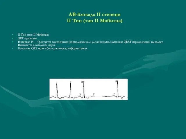 АВ-блокада II степени II Тип (тип II Мобитца) II Тип (тип II