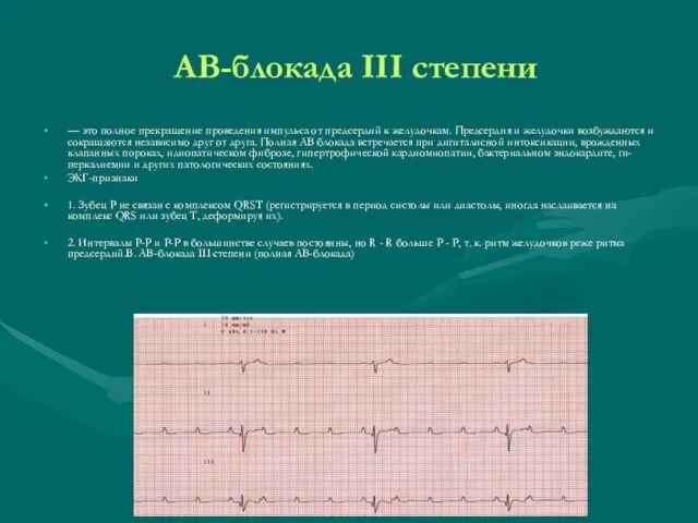 АВ-блокада III степени — это полное прекращение проведения импульса от предсердий к