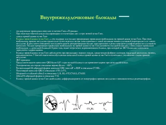 Внутрижелудочковые блокады — это нарушение проведения импульса в системе Гиса—Пуркинье. При этом