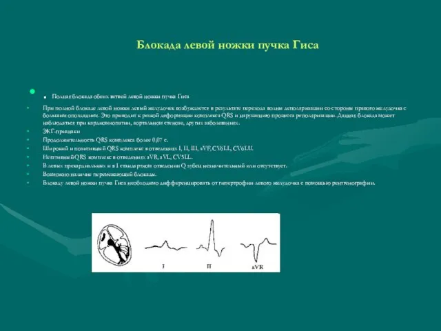 Блокада левой ножки пучка Гиса . Полная блокада обеих ветвей левой ножки