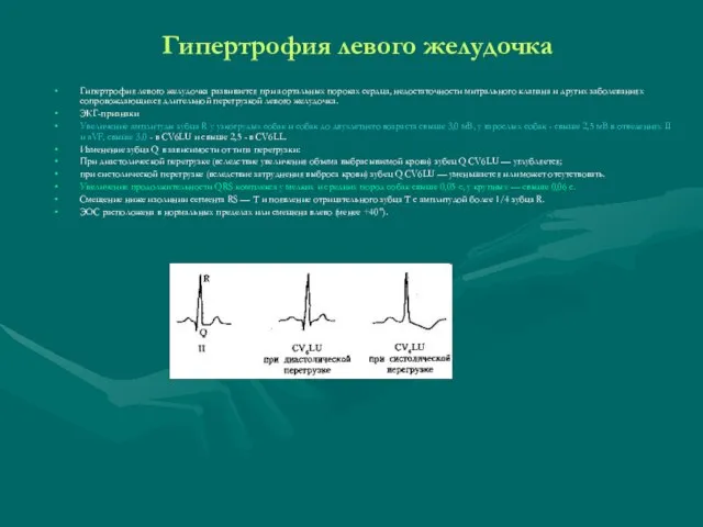 Гипертрофия левого желудочка Гипертрофия левого желудочка развивается при аортальных пороках сердца, недостаточности